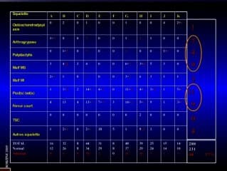 Quand demander un caryotype foetal devant un signe échographique au 2eme trimestre ? Squelette et os longs courts. Pieds bots, Malf génito-urinaires