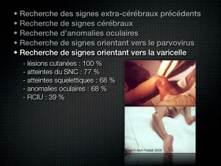 Imagerie des infections materno-foetales