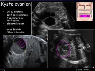 Les images liquidiennes abdominales autres que digestives