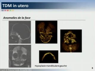 La face foetale Un spectre bien caché