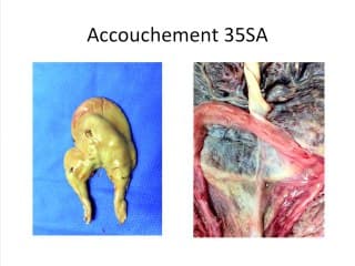 Quelles indications pour la radiofréquence dans les complications des grossesses monochoriales : à propos d'un cas
