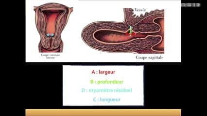 Cavité utérine : challenge en reproduction Isthmocèle, synéchies (Live sur simulateur)