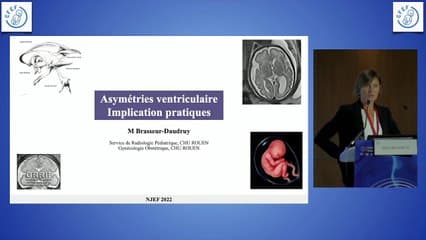 Les asymétries ventriculaires : implications pratiques