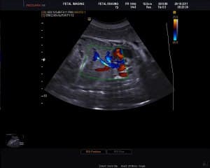 dem live du bilan de rciu  ( en ANGLAIS )