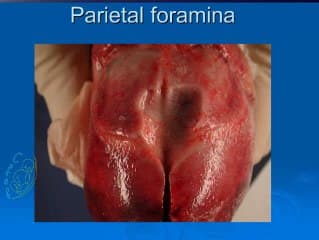 Dysplasie corticocérébelleuse