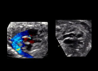 Malformations cardiaques : De la transpositiondes gros vaisseaux au ventricule àdouble issue ?