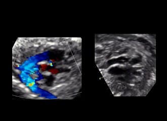 Malformations cardiaques : De la transpositiondes gros vaisseaux au ventricule àdouble issue ?