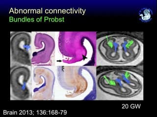 IRM nouvelles possibilités : imagerie de diffusion (DWI),spectroscopie, IRM fonctionnelle