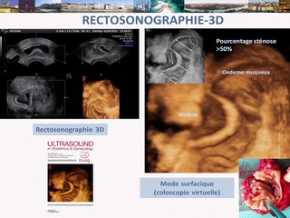 La rectosonographie 3D (écho 3D avec opacification rectale) peut-elle remplacer l’écho-endoscopie rectale dans le bilan d’une endométriose digestive ?