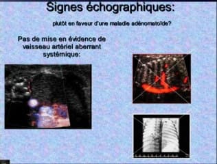 Maladie kystique adenomatoide pulmonaire MAKP