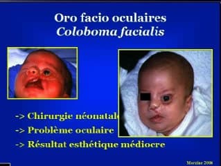Les malformations de la face
