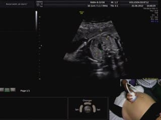L'examen du coeur : Démonstration « live » de l?examen segmentaire du coeur : « step by step »