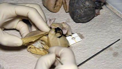 Les CIV comment mieux les dépister et identifier celles qui nécessitent une gestion particulière ? Démonstration