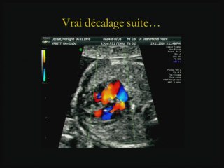 Insuffisances, incertitudes, difficultés, piéges et erreurs de l'imagerie anténatale Le coeur.
