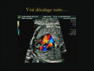 Insuffisances, incertitudes, difficultés, piéges et erreurs de l'imagerie anténatale Le coeur.