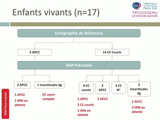 Diagnostic prénatal des corps calleux courts.