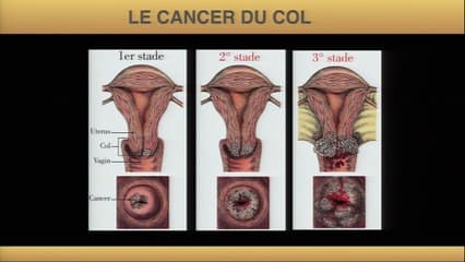 Échographie du cancer du col de l'utérus Présentation des données d'imagerie en échographie et images de fusion