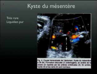 Kyste du cholédoque