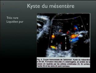 Kyste du cholédoque