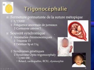 Anomalies des sutures crâniennes : imagerie, syndromes
