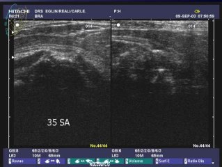 Diastematomyélie