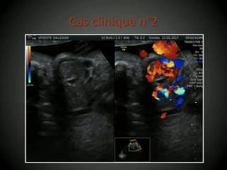 58 Goitres thyroïdiens foetaux dyshormonogénétiques. A propos de deux cas  et revue de