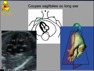 Les quatre cavités : de la coupe des 4 cavités aux coupes complémentaires