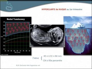 Echographie normale et pathologique du premier trimestre: jusqu’où aller, ce qu’il faut essayer de ne pas rater