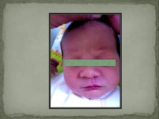 Fente pseudo cicatricielle