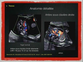 Il y a un foetus autour de sa nuque : Examiner autrement le foetus de 12 semaines : face, cerveau, rachis, coeur, membres, abdomen, qu’est-ce qui peut être décrit au 1er trimestre ? Comment s‘expriment au 1er trimestre les pathologies classiquement vues a