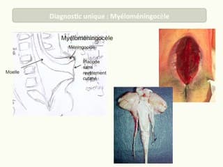 Conduite de l'examen échographique devant un dysraphisme