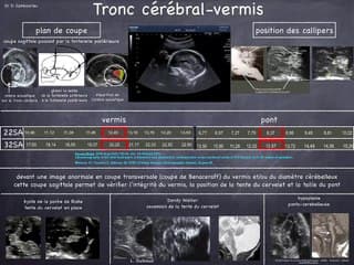 POSTER Tronc cérébral-Vermis