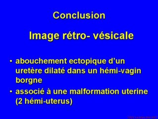 Urétérocèle