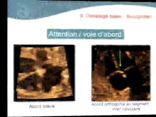 Comment s’orienter à partir de la coupe 4 cavités ?