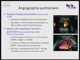 La hernie diaphragmatique :évaluation pronostique : intérêt de la vascularisation pulmonaire.