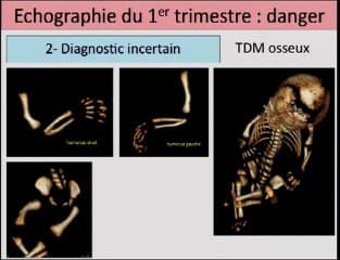 Echographie morphologique au 1er trimestre : Progrès ou danger ?
