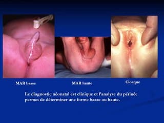 L’intérêt de l’IRM dans le diagnostic des malformations anorectales