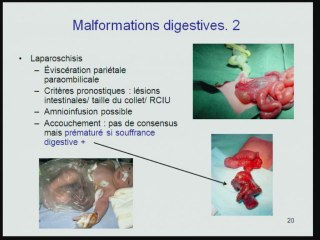 quel terme pour quelle malformation ?