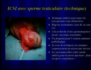 Hypofertilité et syndrome de Klinefelter