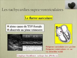 Intérêt de l’imagerie dans le diagnostic et la prise en charge des troubles du rythme cardiaque fœtal