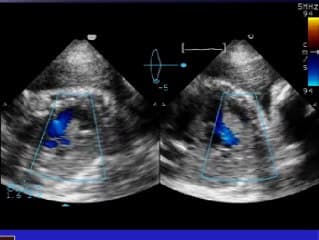 Echographie 3D temps réel : une nouvelle approche du coeur foetal