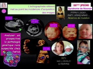 Dialogue échographistes - généticiens.Quand la face regarde...“ :• le corps : syndrome de CHARGE• le cerveau : l’holoprosencéphalie • le cœur : syndrome de Di Georges • les extrémités : syndrome deCornelia de Lange