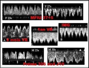L’hémodynamique des coeurs pathologiques, maladie d’Ebstein