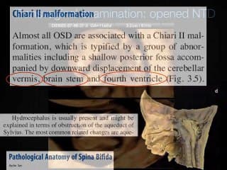 Intracranial translucency