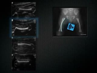 Comment rallonger un fémur