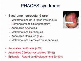 SYSTÈME NERVEUX CENTRAL : Bibliographie : l’article de l’année syndrome PHACE
