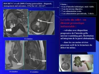 Les anomalies digestives à révélation tardive au 3eme trimestre