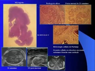 syndrome de ZELLWEGER