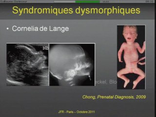 Diagnostic d'un retard de croissance intra-utérin (RCIU)