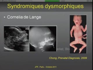 Diagnostic d'un retard de croissance intra-utérin (RCIU)